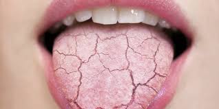 how does dry mouth affect your and