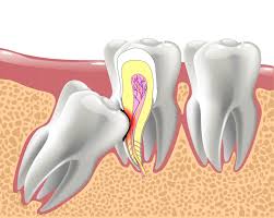impacted wisdom teeth dallas dentist