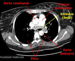 Plicní embolie je život ohrožující onemocnění, při kterém dochází k náhlé obstrukci plicnice (hlavní tepna přivádějící krev do plic), nebo některé z jejích větví, především krevní sraženinou. Plicni Embolie Ct Angiografie Medicina Nemoci Studium Na 1 Lf Uk
