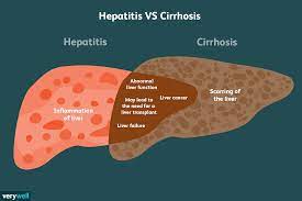 Hepatitis and Cirrhosis Similarities ...