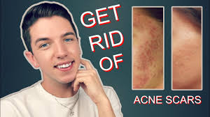 get rid rid of acne scars completely