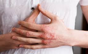 how to manage hand eczema eczema less