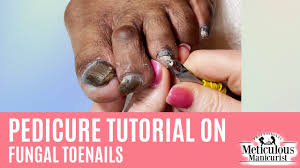 dark toenails with nail fungus