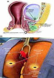 surgery for anorectal abscess