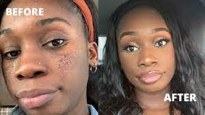 makeup for deep pitted acne