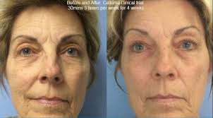 Led Facials Bora Lea Skin Therapy Bora Lea Skin Therapy