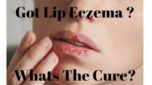 do you have eczema on your lips what