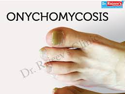 homeopathic treatment for onychomycosis