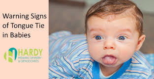 7 warning signs of tonge tie in infants