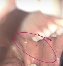 blood blister inside of cheek in mouth