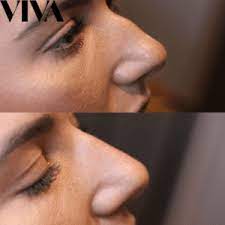 nose filler treatment