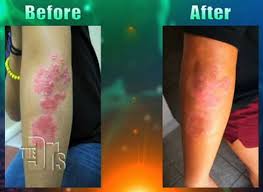 What Is Psoriasis Ahb