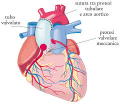 Risultati immagini per cuore con valvola cardiaca artificiale