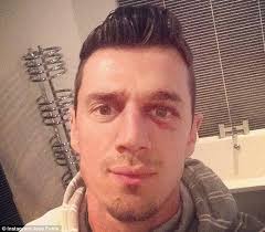 Shiner: Jose Fonte took to Instagram to show off his black eye as a result of his bust up with Dani Osvaldo - article-2547734-1AEEFA8B00000578-588_634x554
