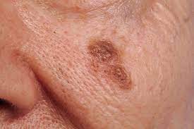 melanoma skin cancer symptoms nhs