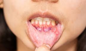 canker sores on the lips causes