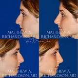 Image result for How Much Does Non-Surgical Nose Job Cost In South Africa