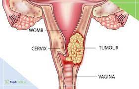 survival rate of cervical cancer