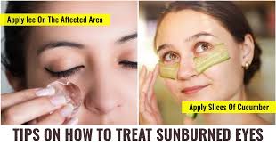 how to treat sunburned eyes