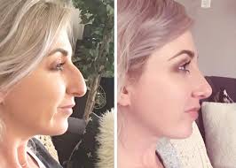 before after your rhinoplasty surgery