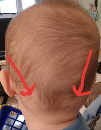 soft lumps base of baby s head mumsnet