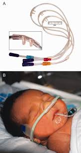 High Flow Oxygen Administration By Nasal Cannula For Adult