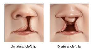 cleft lip palate top hair transplant