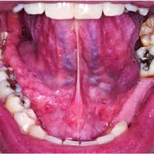normal floor of mouth