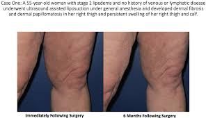 lymphatic injury after liposuction