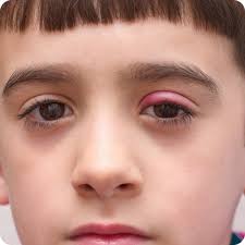 swollen eyelid treatment