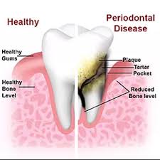 Image result for Periodontal disease