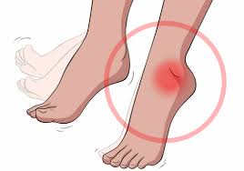 foot drop drop foot syndrome