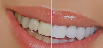 teeth whitening photo app whiten