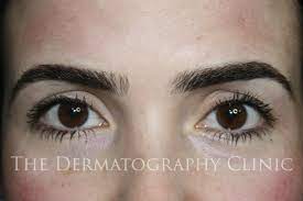 permanent eyebrows the dermatography