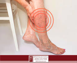 spider veins are a sign of a deeper