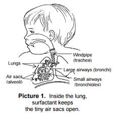 Transient tachypnea of the newborn (wet lung disease) 10. Respiratory Distress Syndrome Rds In Newborns Diagnosis Treatment