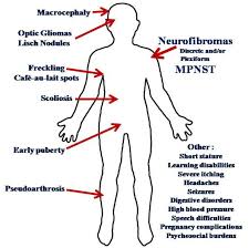 Most kids with nf1 have mild symptoms that don't limit what they can do. 2 Nf1 Manifestations The Disease Neurofibromatosis Type 1 Nf1 Has Download Scientific Diagram