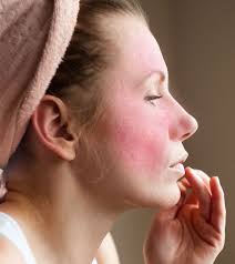 home remes to reduce redness on the
