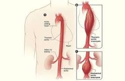 Image result for icd 10 code for ruptured aortic aneurysm