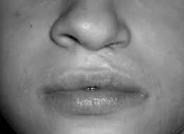 lip scar after cheiloplasty according