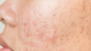 remove acne scars naturally