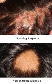 alopecia areata hair loss in patches