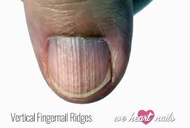 vertical ridges on nails causes