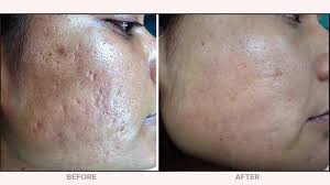Microdermabrasion before and after for wrinkles 2020 how to home microdermabrasion devices work. Microdermabrasion Vs Microneedling Cost Results Methods