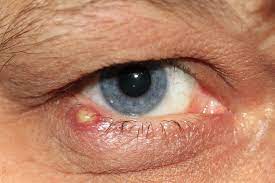 eye infections a guide to causes