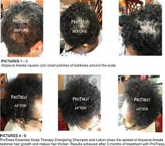 The hairstyle should accentuate the positive rather than covering thinning or balding areas. Why Is My Afro Hair Falling Out Protress Hair Care