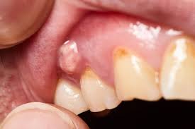 gum blister 7 common causes what to