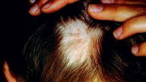 Alopecia is loss of hair that comes in a variety of patterns with a variety of causes, although often it is idiopathic. Aktuelles Zur Alopecia Areata Springerlink