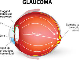 Diabetes Related Glaucoma Retina Internationals Diabetic