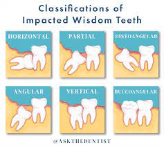 How long does wisdom tooth pain last. Wisdom Teeth Pictures Symptoms Surgery Pain Relief Ask The Dentist